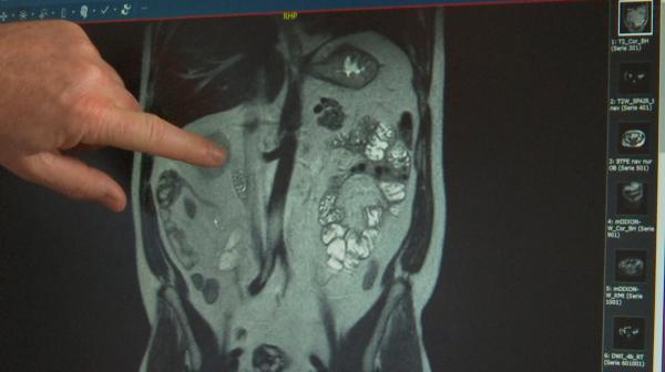 Bild 1 von 4: Monitorbild einer von Krebs befallenen Niere.