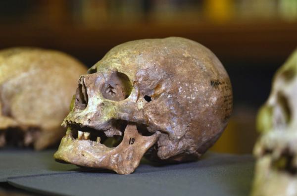 Bild 1 von 3: Die Schädel der Bewohner von Toulouse des 19. Jahrhunderts hatten seltsame Verformungen.